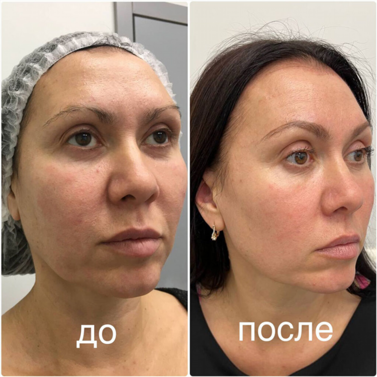 Rf лифтинг калининград